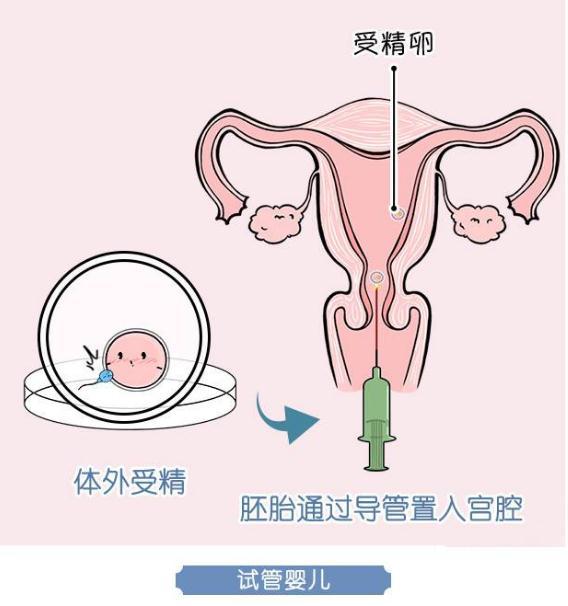 最新人工授精成功率研究，發(fā)展趨勢分析與成功率探討