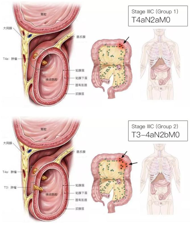 腫瘤TNM分期標(biāo)準(zhǔn)最新概述及更新解析